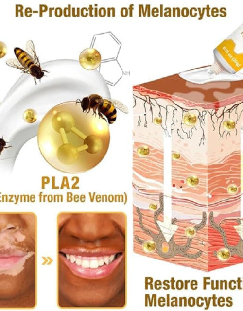 Bee Venom Vitigo Correcting Cream - (Pack of 2)